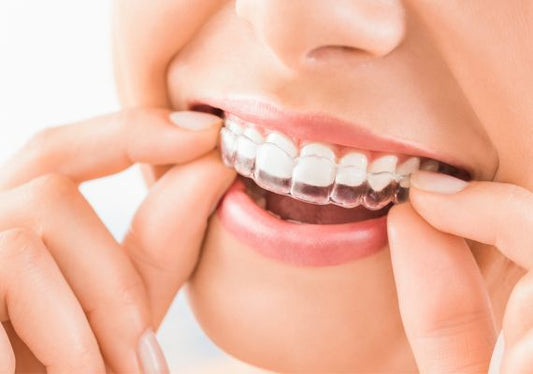 What are aligners?