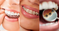 Teeth straightening: Guide to options, cost & results