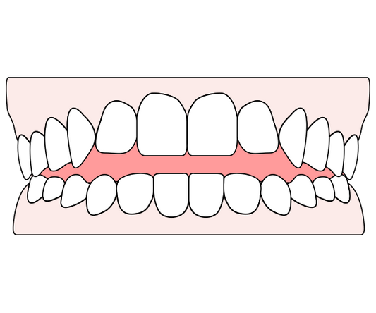 image of how open bites look like