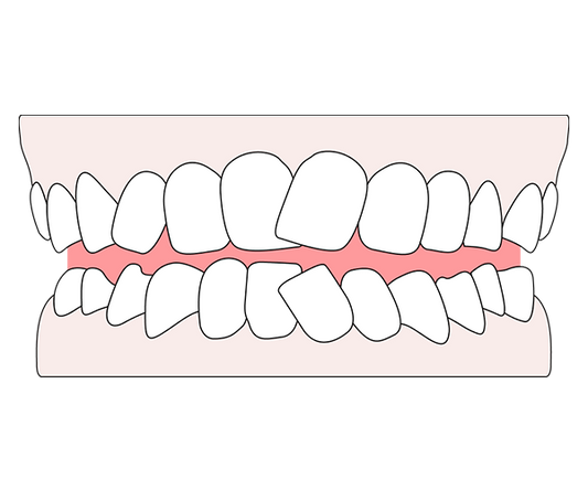 An image of a person showing crooked teeth