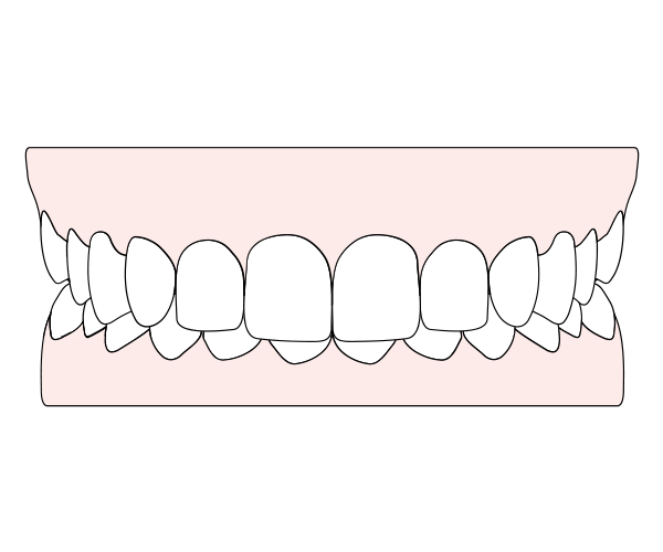 A girl is holding a caspersmile clear aligner