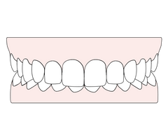 Understanding deep bites: Causes, concerns, and corrections