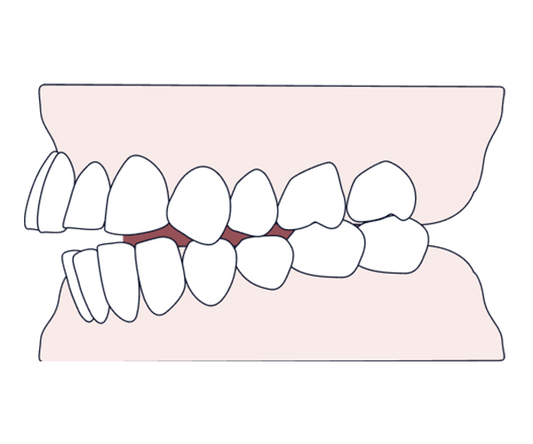 All you need to know about overjet- causes, types, & treatment