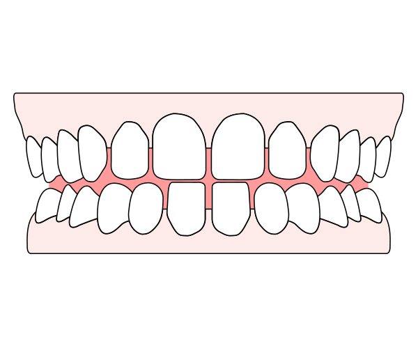 An illustration showing gapped teeth