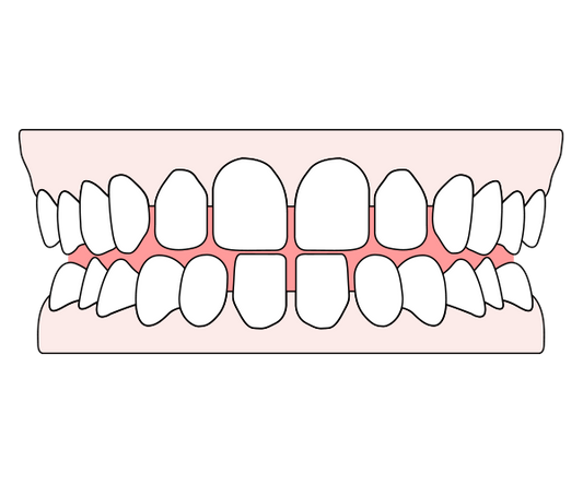 An illustration showing gapped teeth