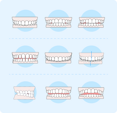 Malocclusion explained: Types, causes, and treatment options