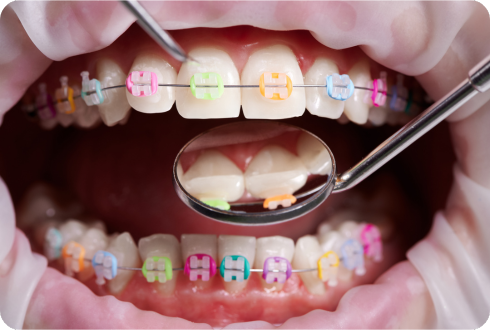 A close-up image of teeth with colorful braces