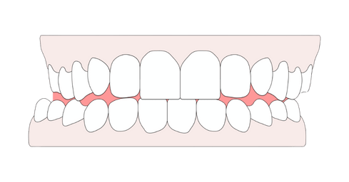 What is a crossbite? Causes, effects, & treatment options