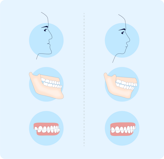 What an underbite and an overbite look like