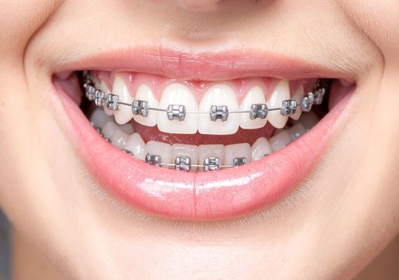 A girl is wearing braces