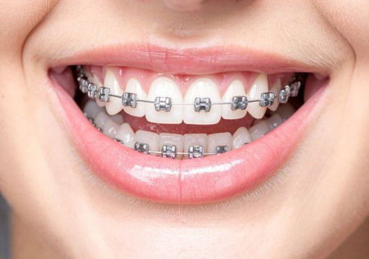 A girl is wearing braces