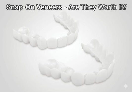 Snap-on veneers – Are they worth it?