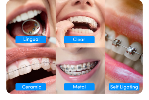 An illustration shows different types of braces