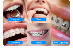 Braces cost in the uk for 12-year-olds: What parents should know