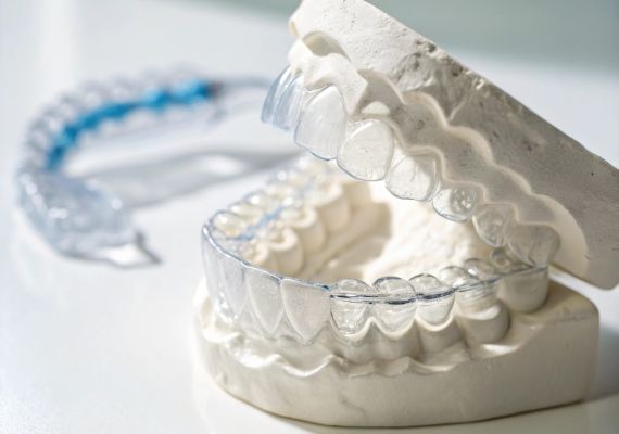 An image of clear aligners on a dental model 