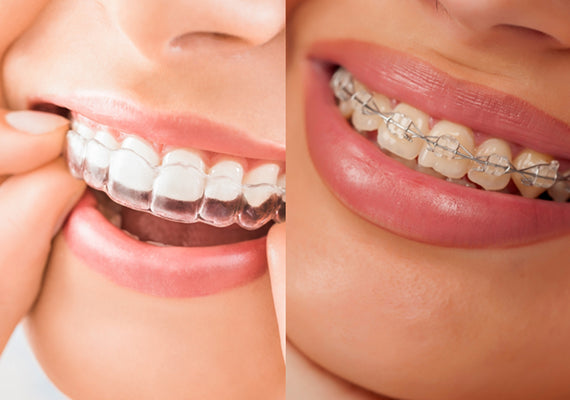 An image showing clear braces and ceramic braces side by side.