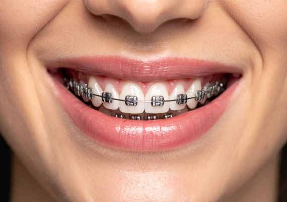 An image of a woman wearing braces.