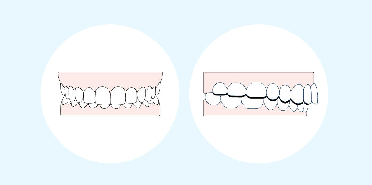 Buck Tooth Drawing Understanding buck teeth: Causes, risks, and effective treatment
