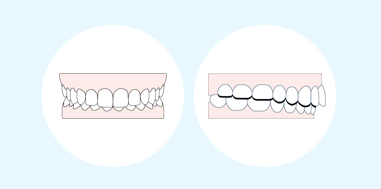 Understanding buck teeth: Causes and treatment options