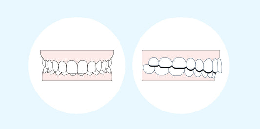 Understanding buck teeth: Causes and treatment options