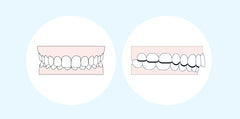 Understanding buck teeth: Causes and treatment options