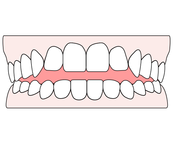 Open bite: causes, treatment & how clear aligners can help