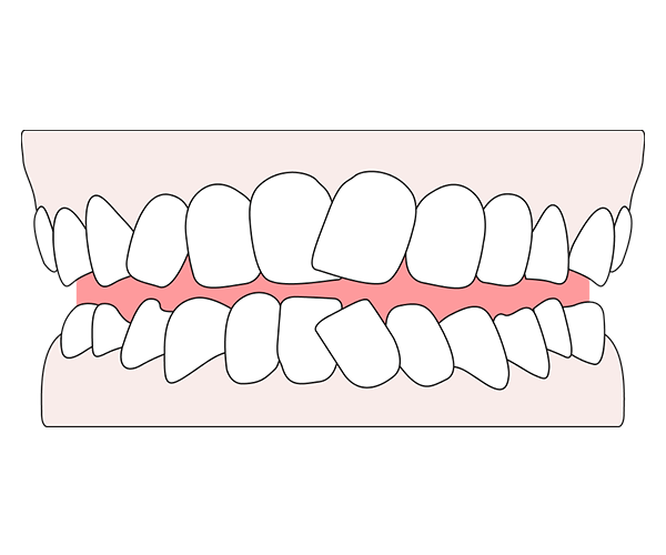 Teeth crowding: causes, treatment & straightening in the UK