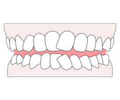 Teeth crowding: causes, treatment & straightening in the UK