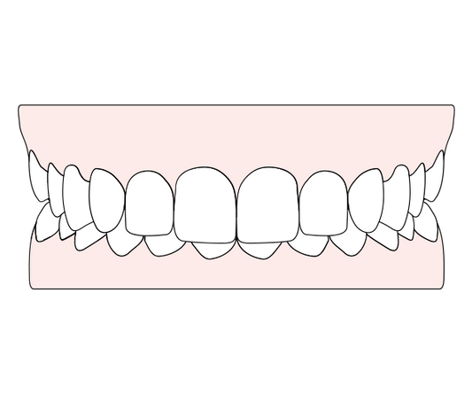 A girl is holding a caspersmile clear aligner