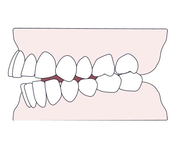 All you need to know about overjet- causes, types, & treatment