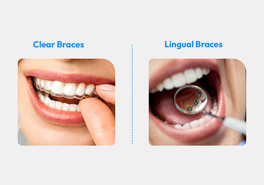 A split image comparing lingual braces and clear aligners