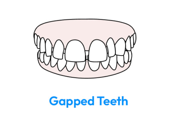An illustration showing gapped teeth.