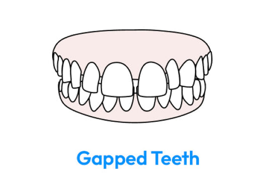 An illustration showing gapped teeth.