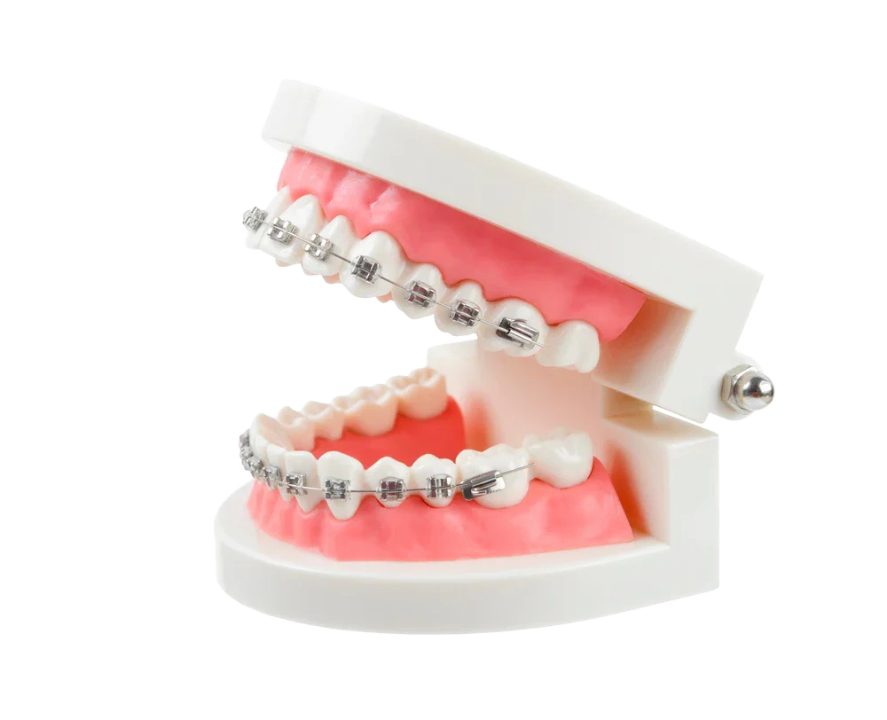Clear braces for adults: What you need to know