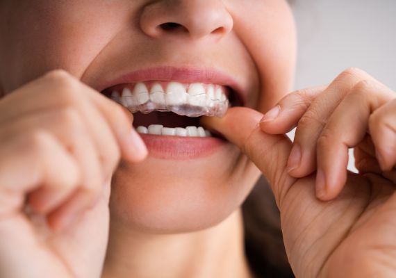 A girl applying clear retainers.