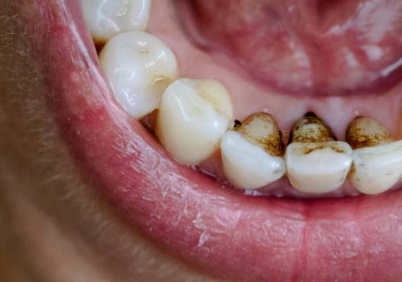 An image shows nicotine and caffeine stains on teeth 