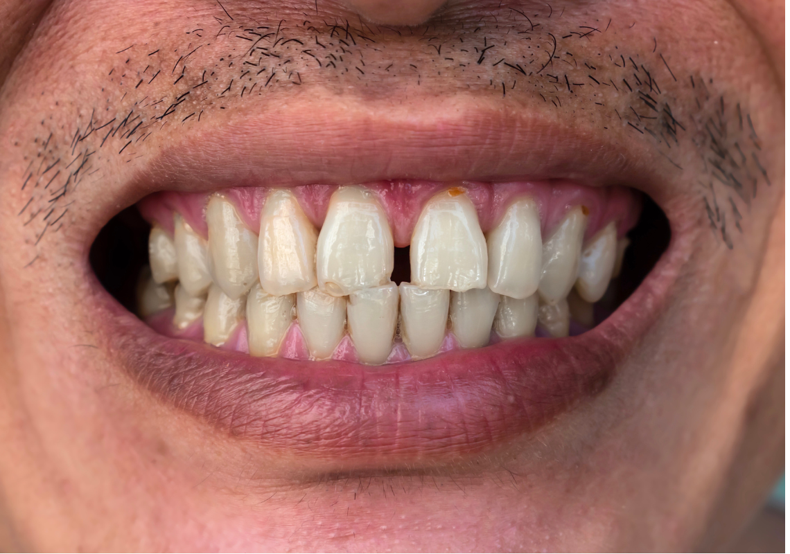 A close-up of a man with a gap in his teeth