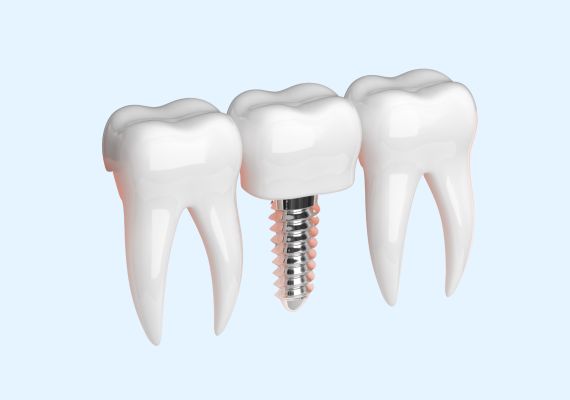 An illustration of a dental implant