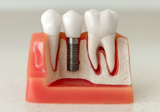 A dental model showing how dental implants work