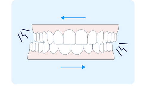 Teeth grinding side-to-side with blue arrows and stress lines representing the pressure of bruxism.