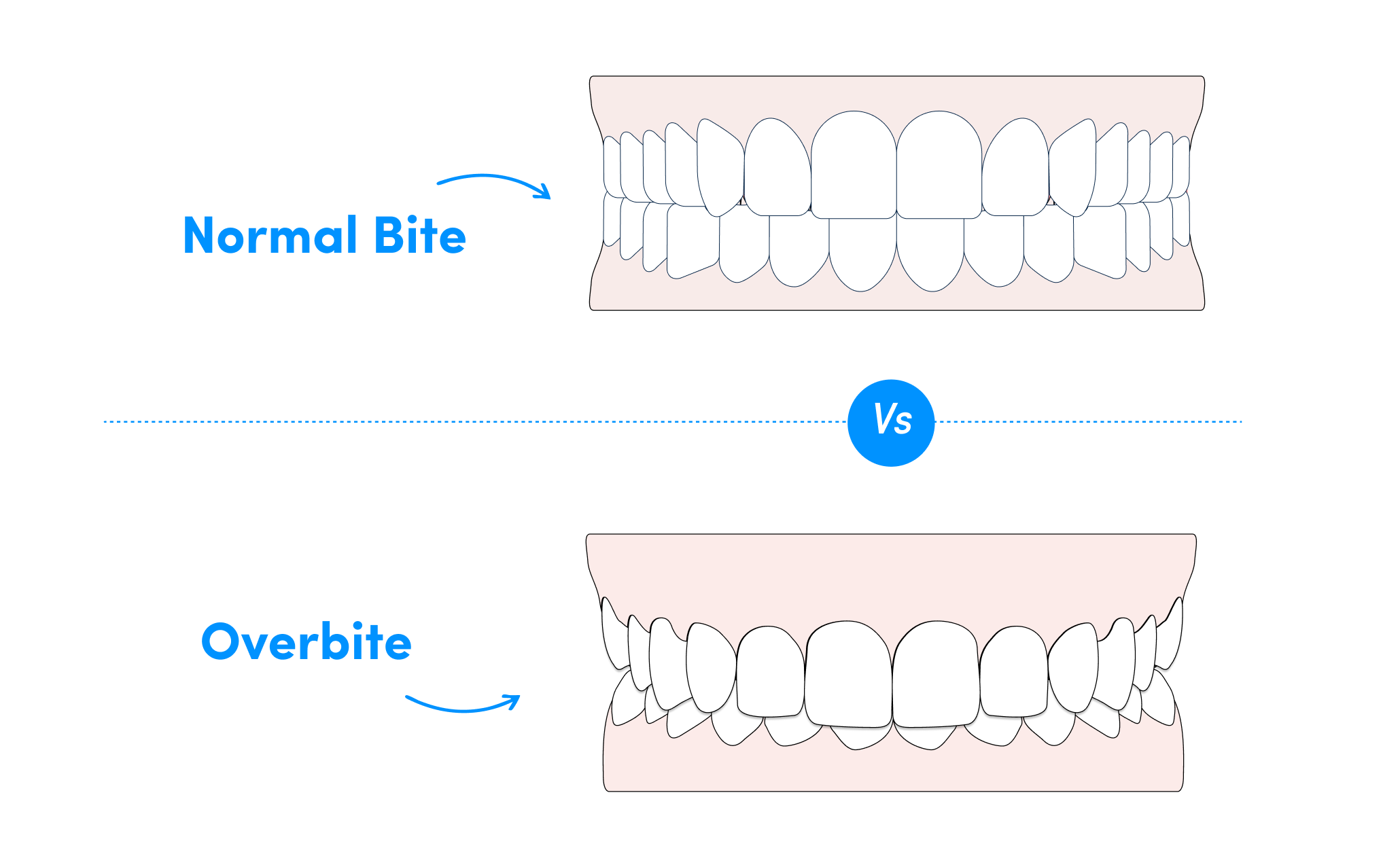 Understand the major differences between an overbite vs normal bite