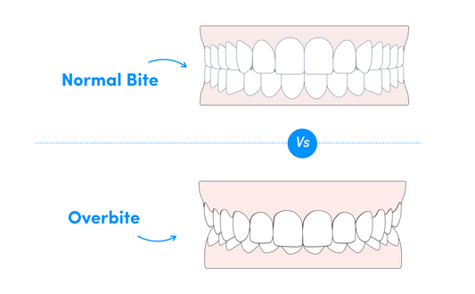 Understand the major differences between an overbite vs normal bite