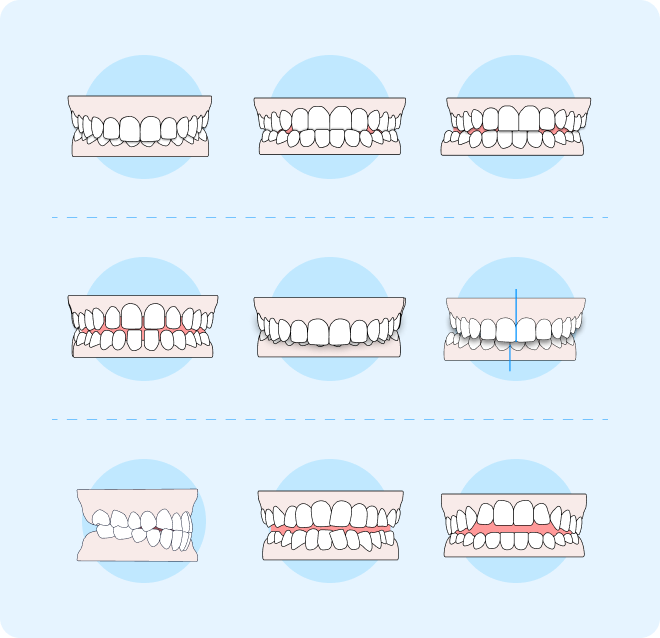 Malocclusion explained: Types, causes, and treatment options