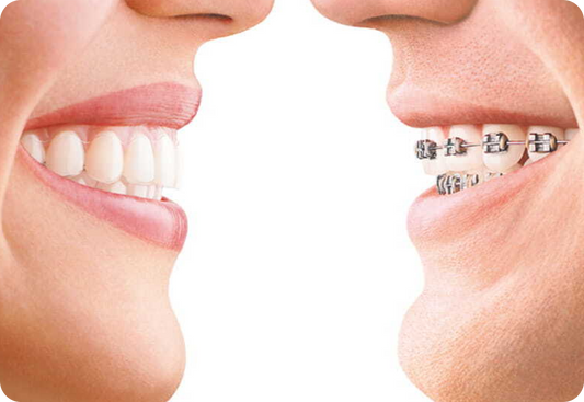 Train track braces vs. clear aligners: Which is more effective?