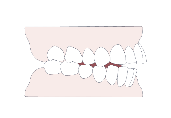 An illustration shows an edge to edge bite