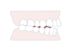 Aligners for edge-to-edge bite: Do they work?