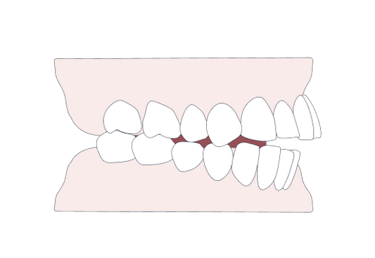 An illustration shows an edge to edge bite