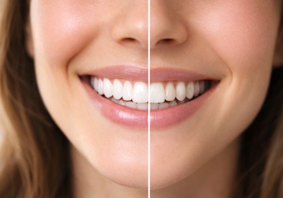 A close-up of a person smiling, showing a comparison of teeth whitening results over time