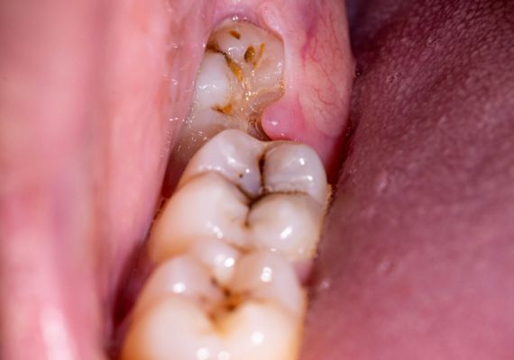 A close-up image of an impacted wisdom tooth