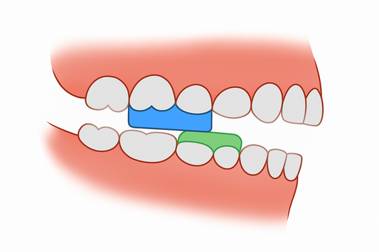 Bite block braces: Enhancing orthodontic treatment